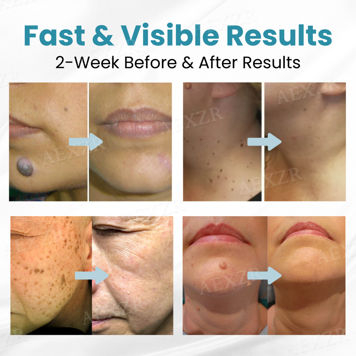 Bikenda® Non-Invasive Mole and Wart Removal Laser Pen Pro