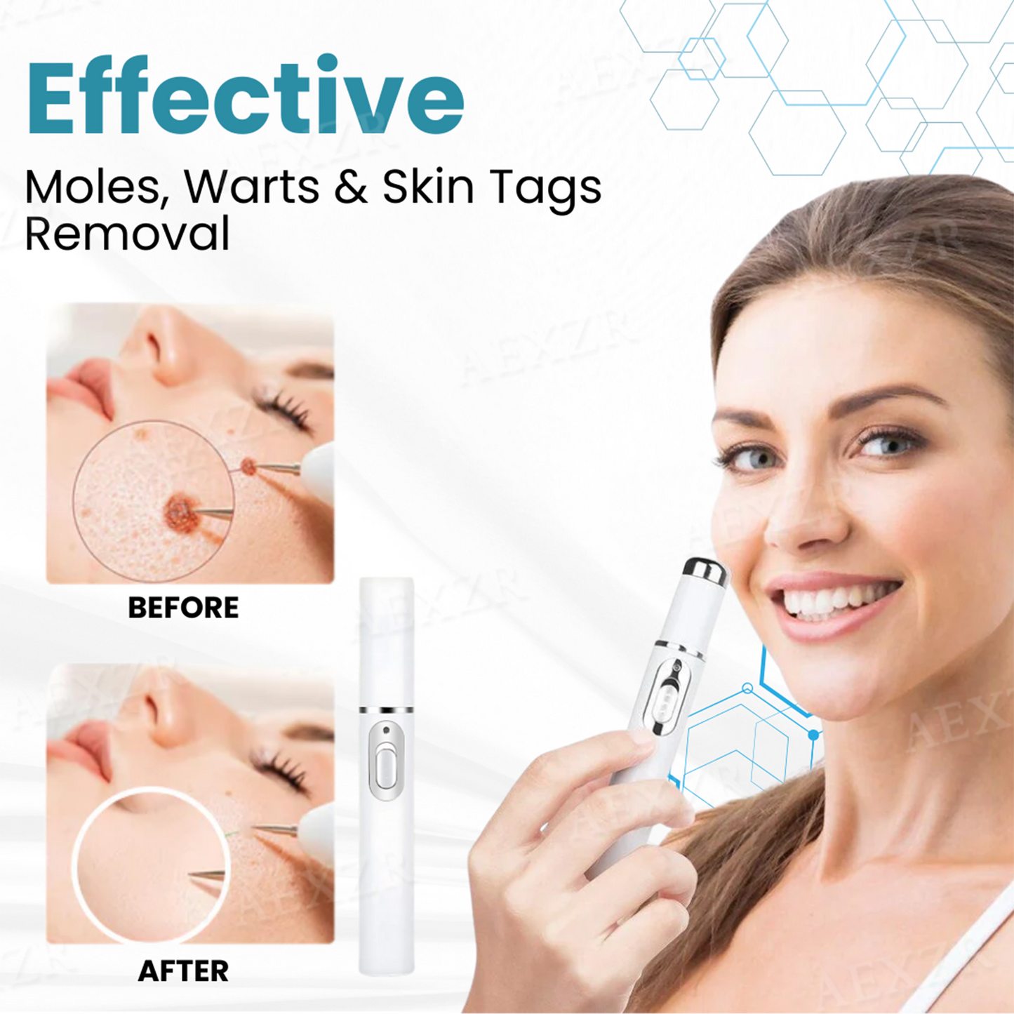 Bikenda® Non-Invasive Mole and Wart Removal Laser Pen Pro